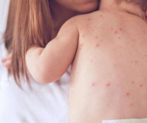 Dấu hiệu nhận biết trẻ mắc bệnh sởi mà cha mẹ cần lưu ý